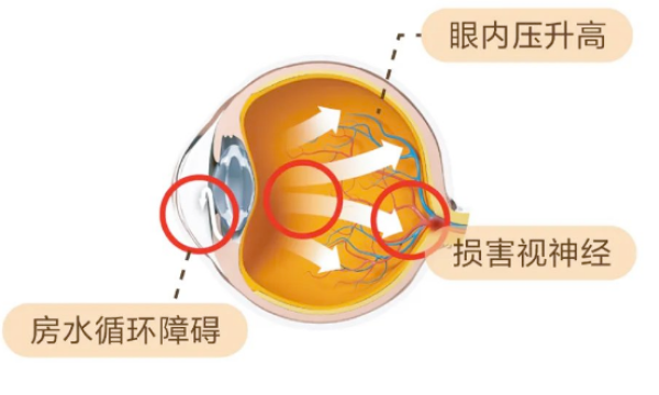 元旦期间，青光眼术后患者一定要少吃这两类食物！